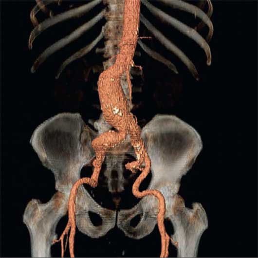 Bild einer CT-Rekonstruktion eines abdominellen Aortenaneurysma