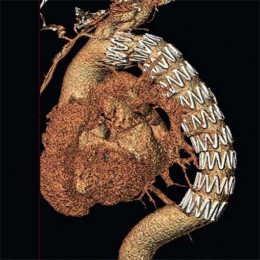 Bilder einer CT-Rekonstruktion nach Implantation einer thorakalen Endoprothese