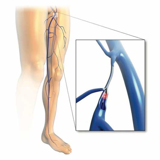 Skizze einer Endovenöse Laser-Ablation der Vena saphena magna nahe der Crosse